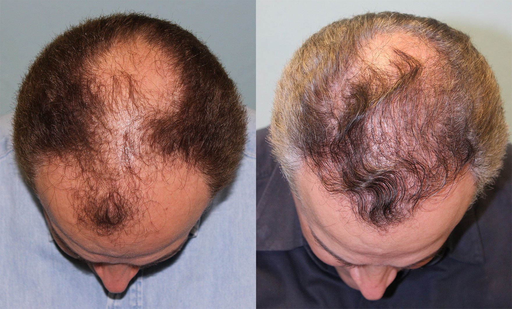 Hair Transplant Before & After #4 image 1