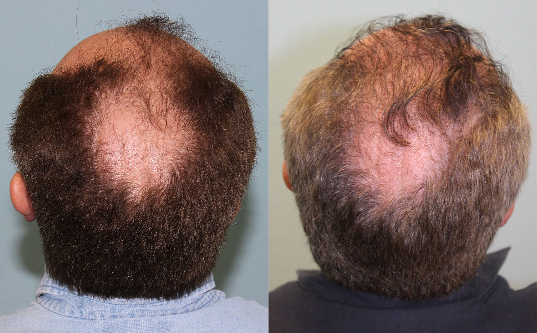 Hair Transplant Before & After #4 image 2