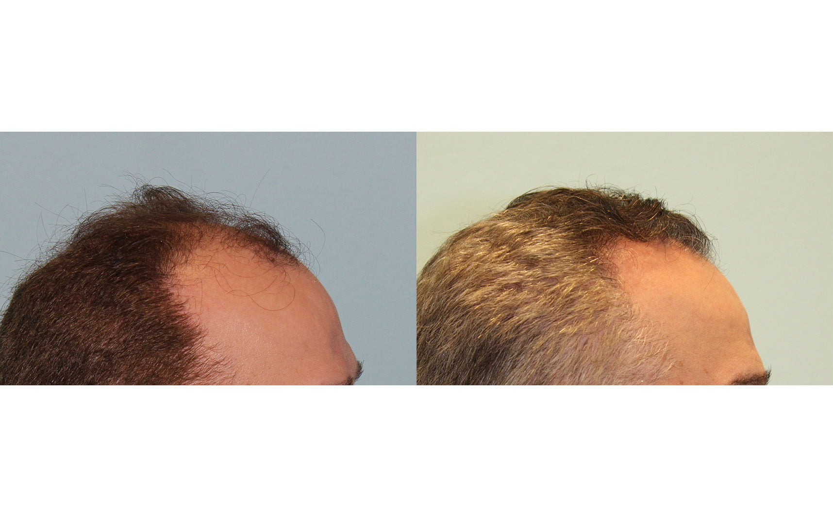 Hair Transplant Before & After #4