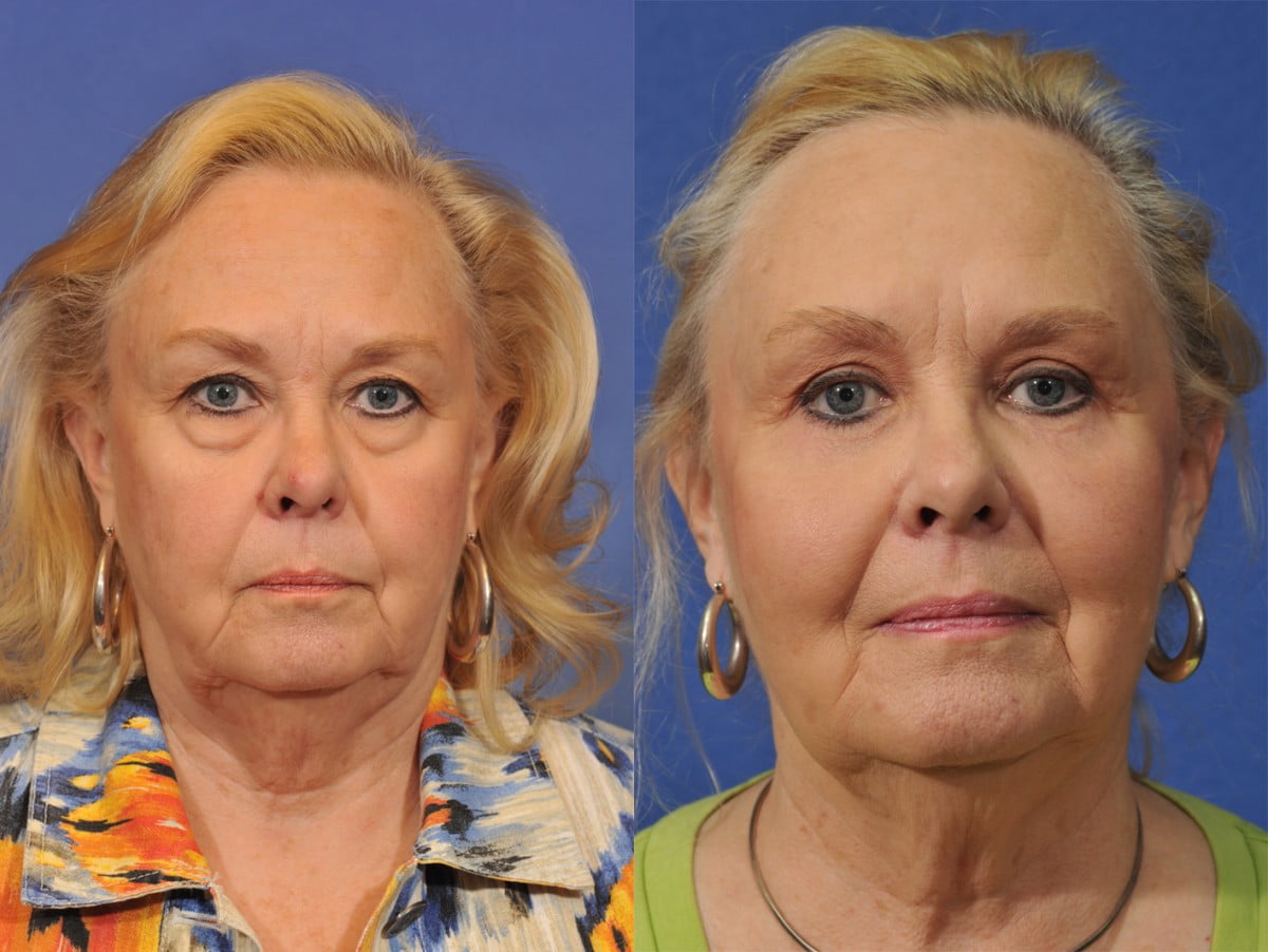 Blepharoplasty Before & After #1