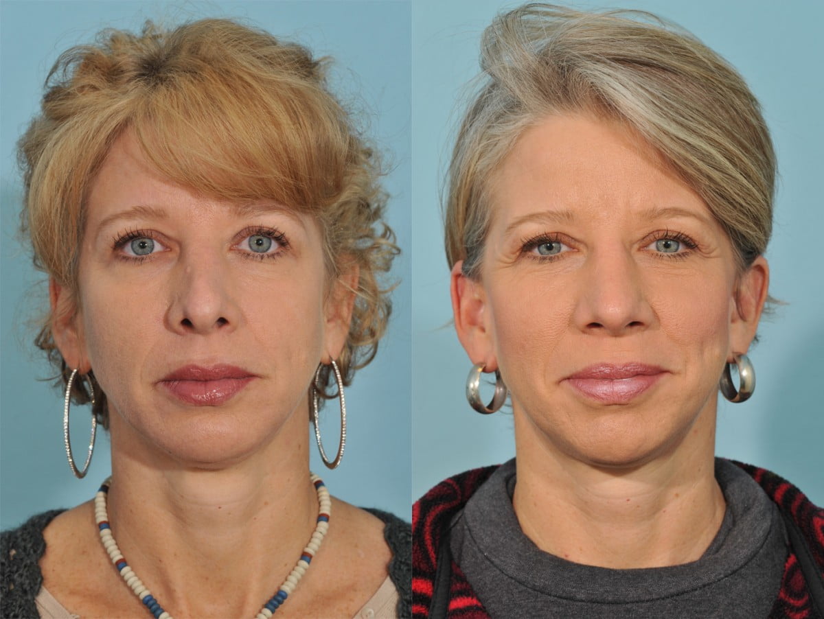 Facelift Before & After #21