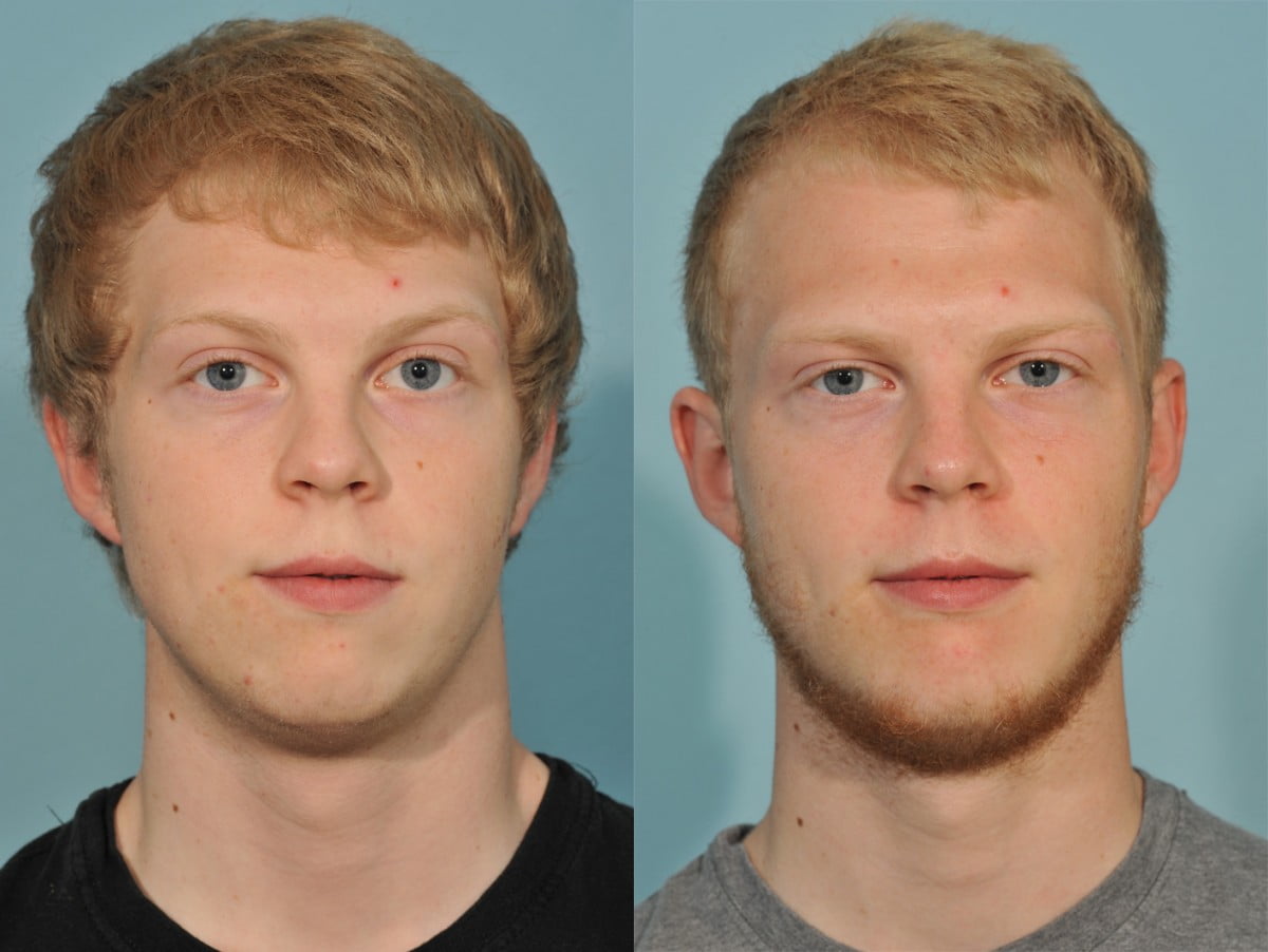 Genioplasty Before & After #1