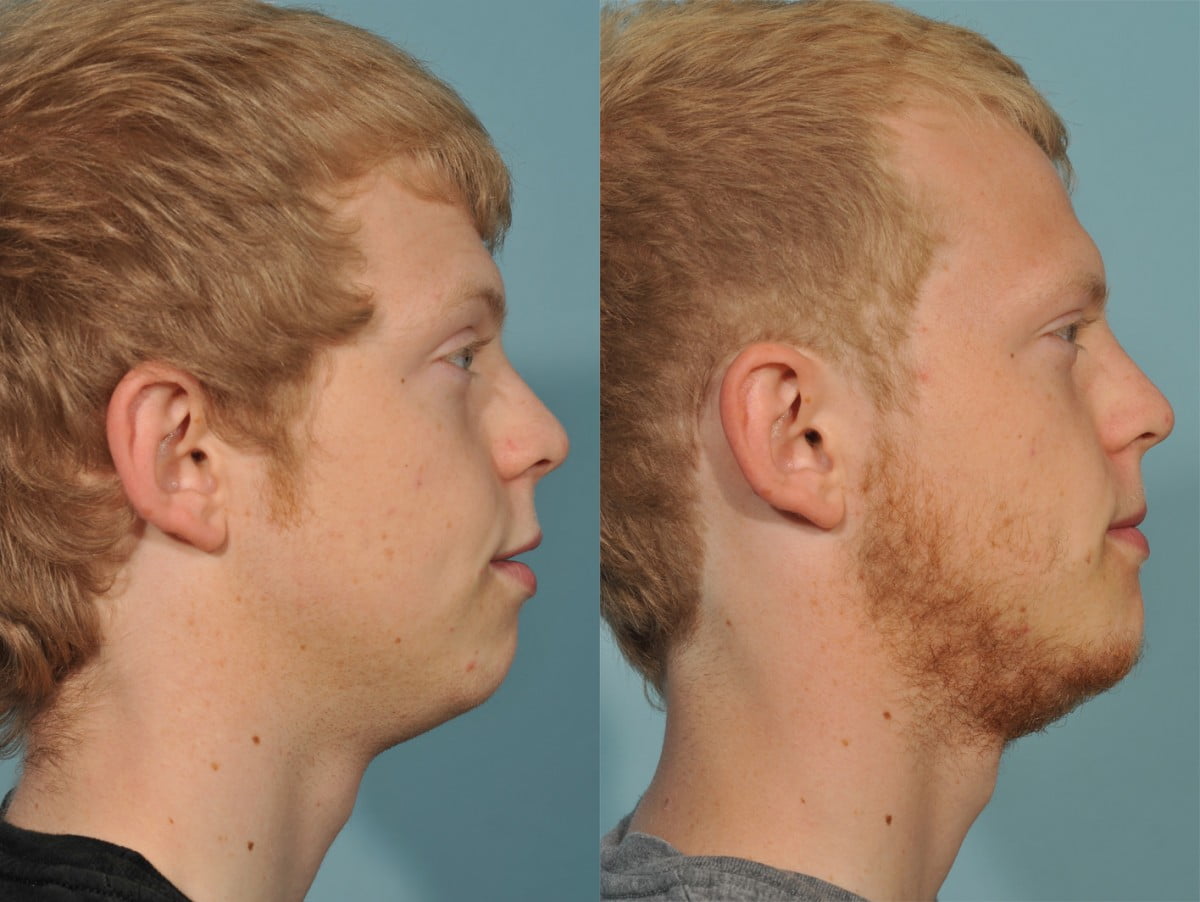Genioplasty Before & After #1