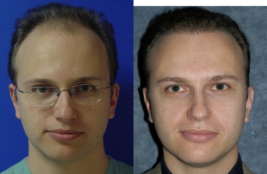 Hair Transplant Before & After #1