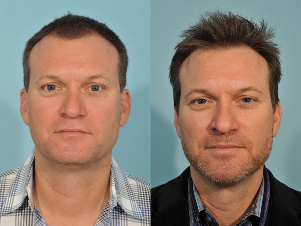 Hair Transplant Before & After #2 before and after