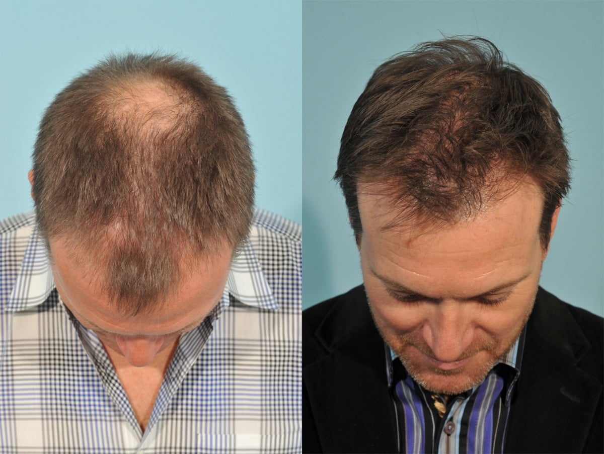Hair Transplant Before & After #2 image 2