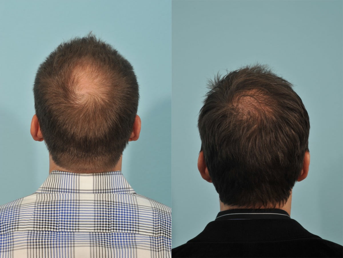 Hair Transplant Before & After #2 image 3