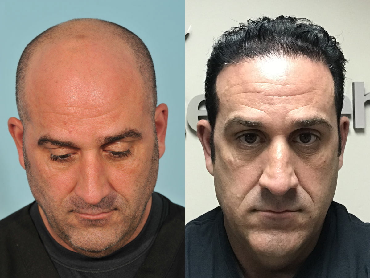 Hair Transplant Before & After #3