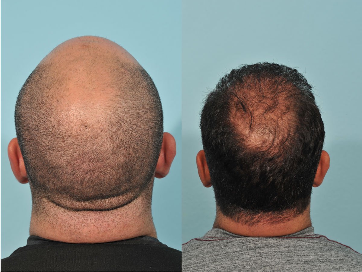 Hair Transplant Before & After #3 image 2