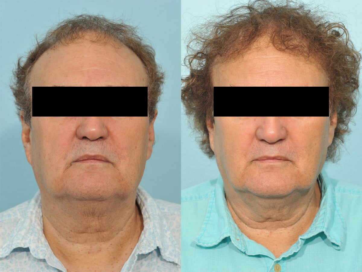 Hair Transplant Before & After #5
