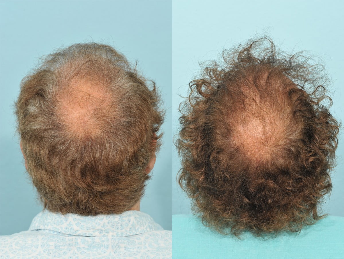 Hair Transplant Before & After #5 image 5