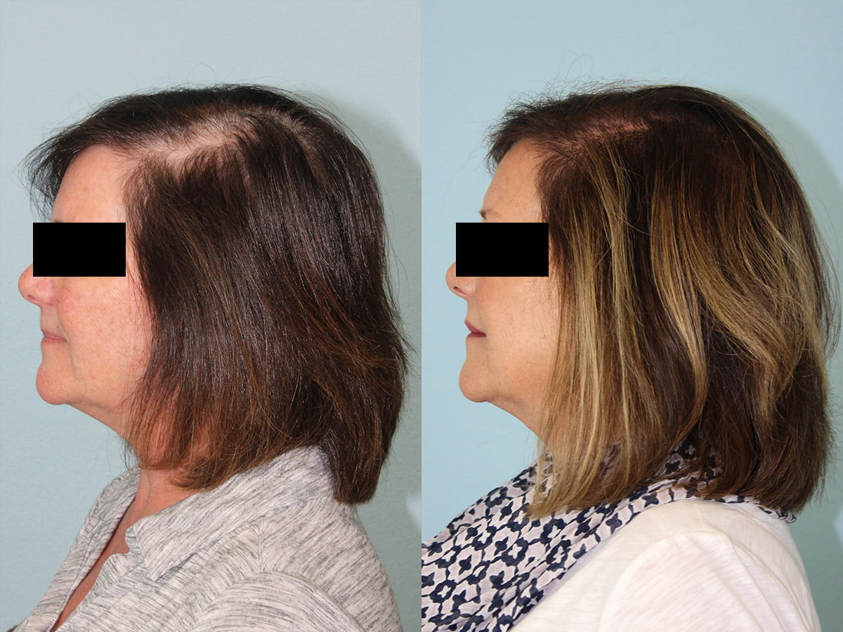 Hair Transplant Before & After #6 image 2