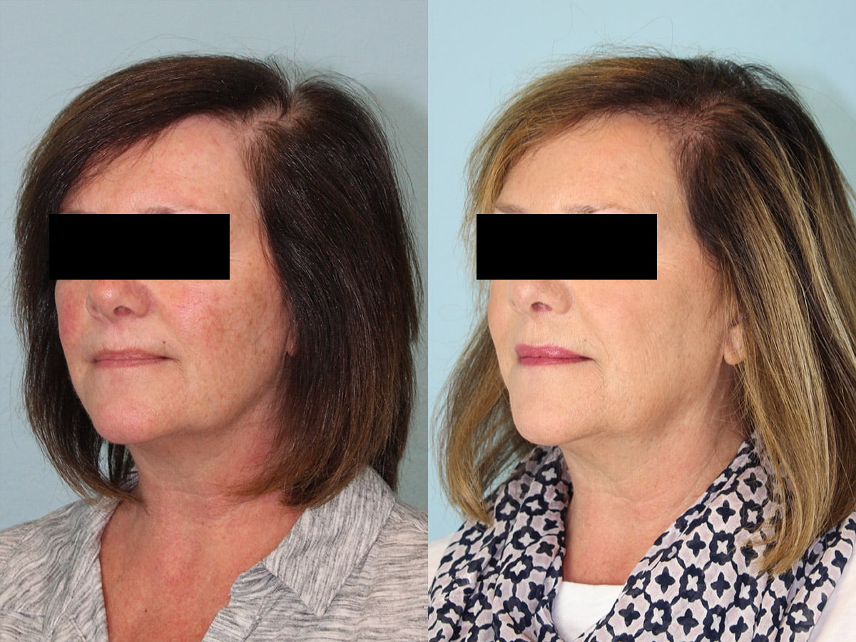 Hair Transplant Before & After #6
