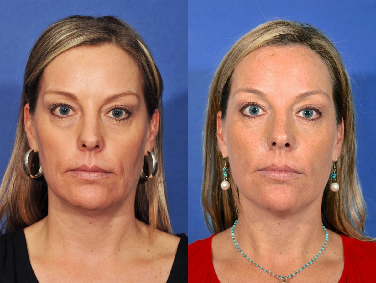 Injectables Before & After #1
