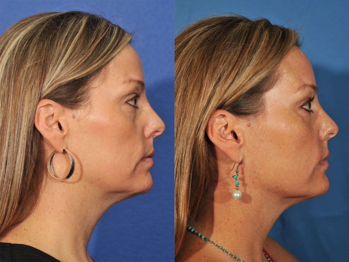 Injectables Before & After #1 image 2