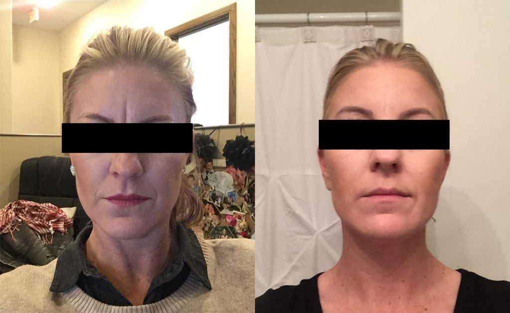 Injectables Before & After #2