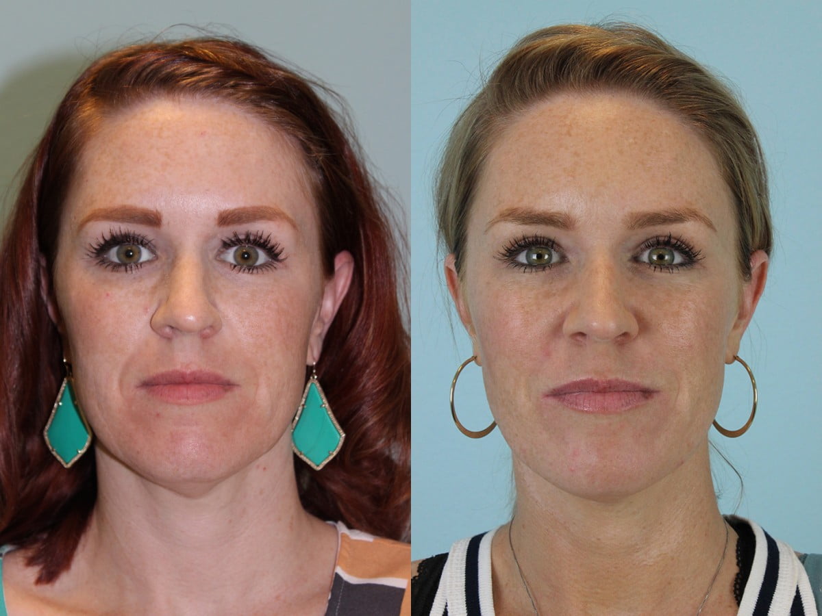 Injectables Before & After #3