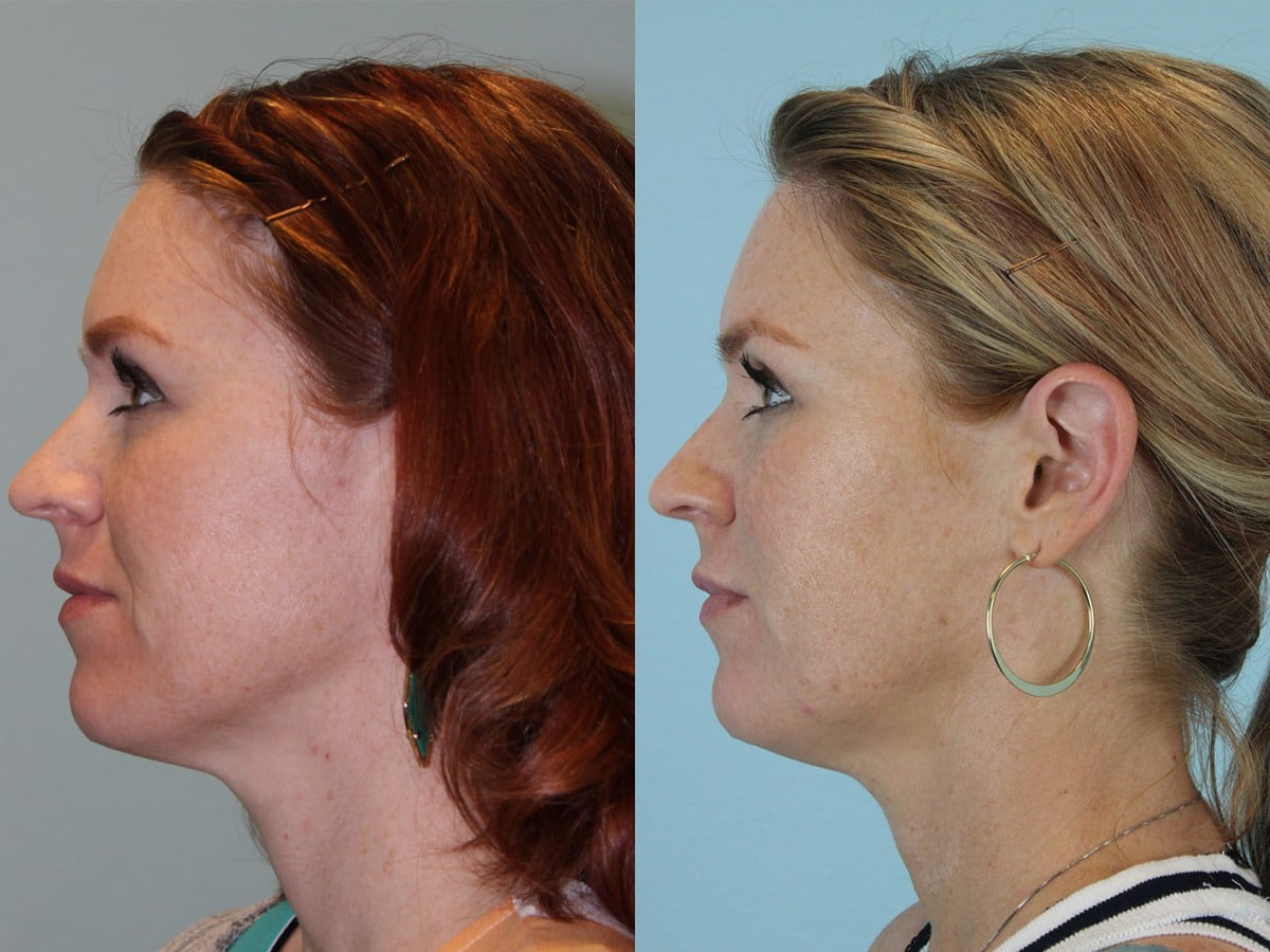 Injectables Before & After #3 image 2