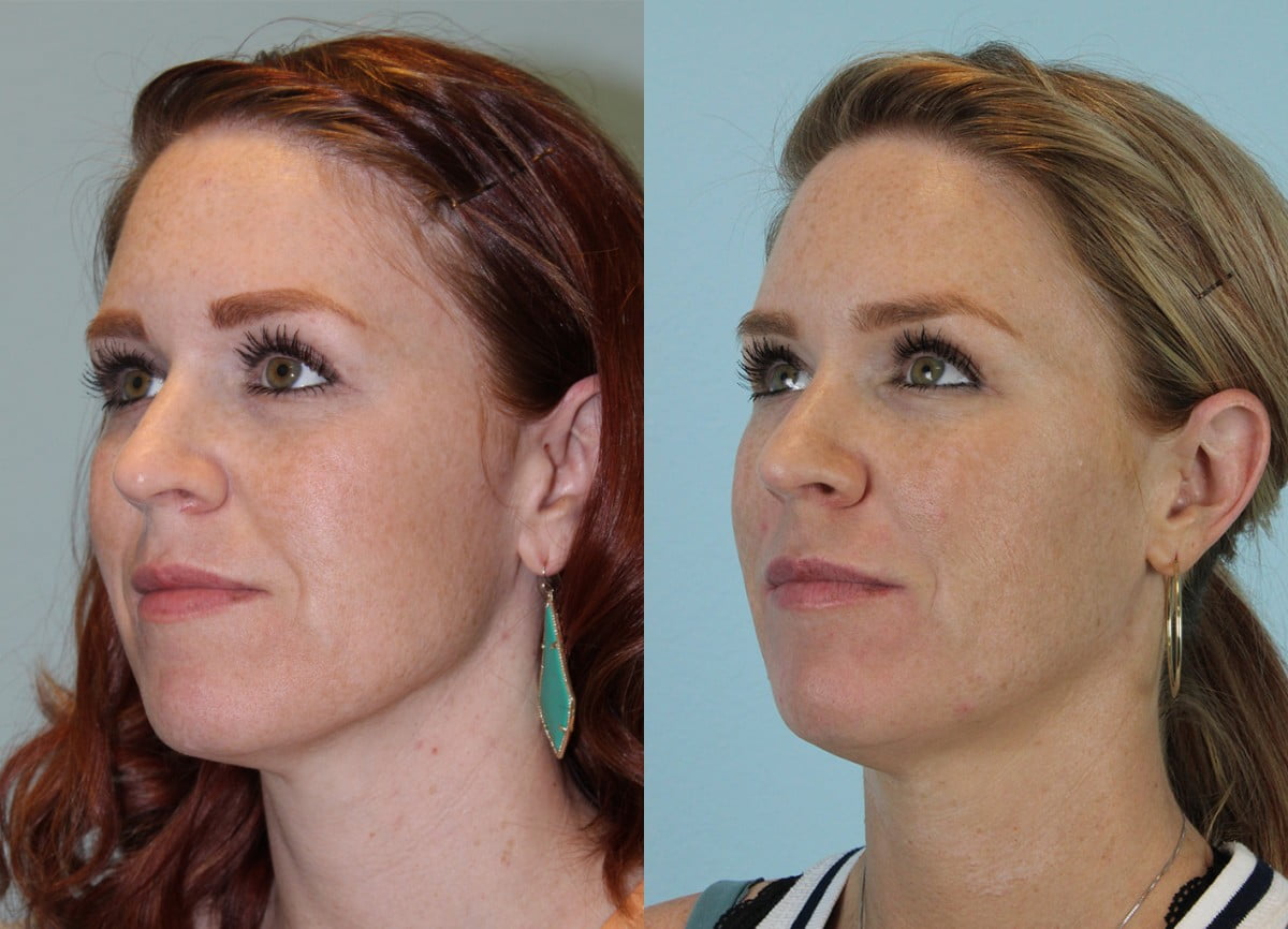 Injectables Before & After #3 image 3