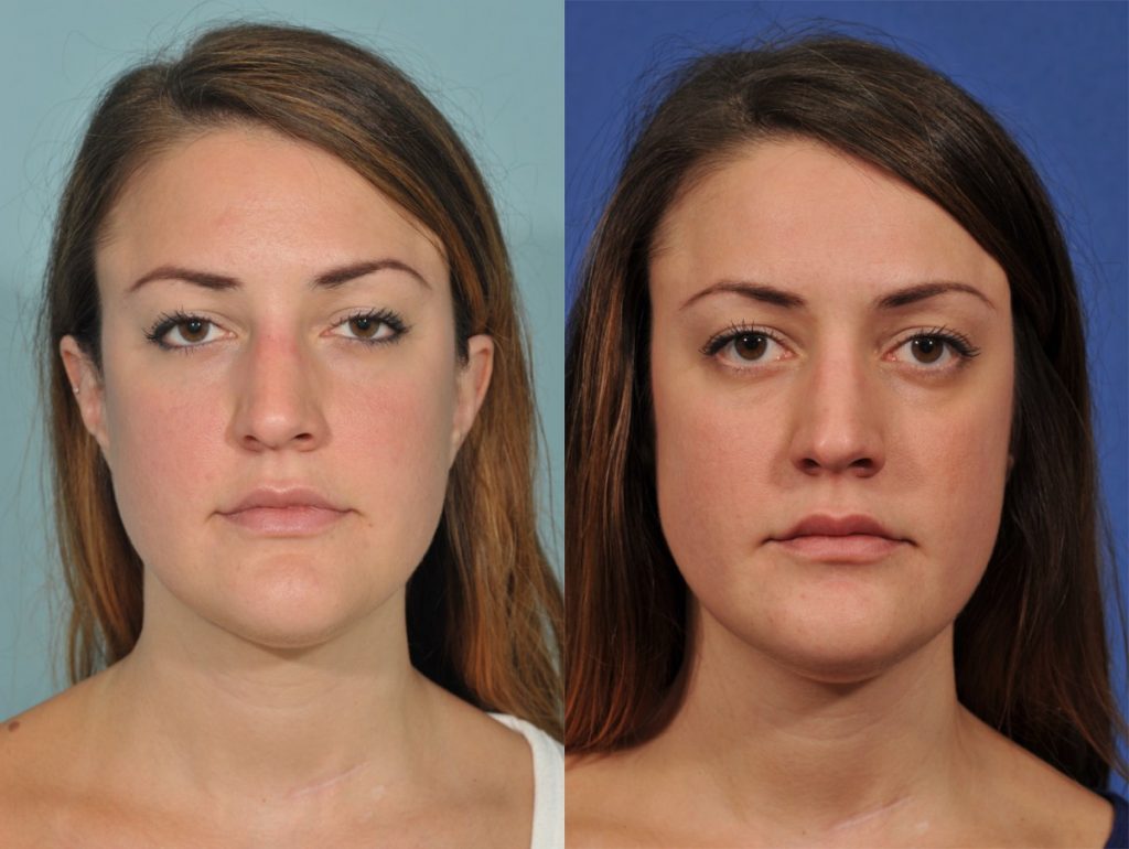 Rhinoplasty Before & After #1 before and after