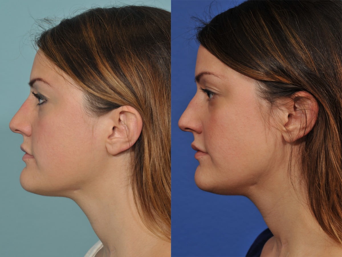 Rhinoplasty Before & After #1 image 3