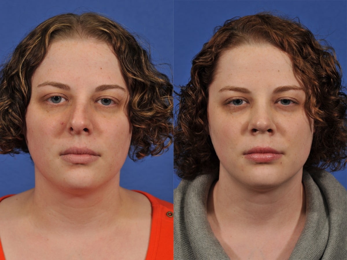 Rhinoplasty Before & After #2