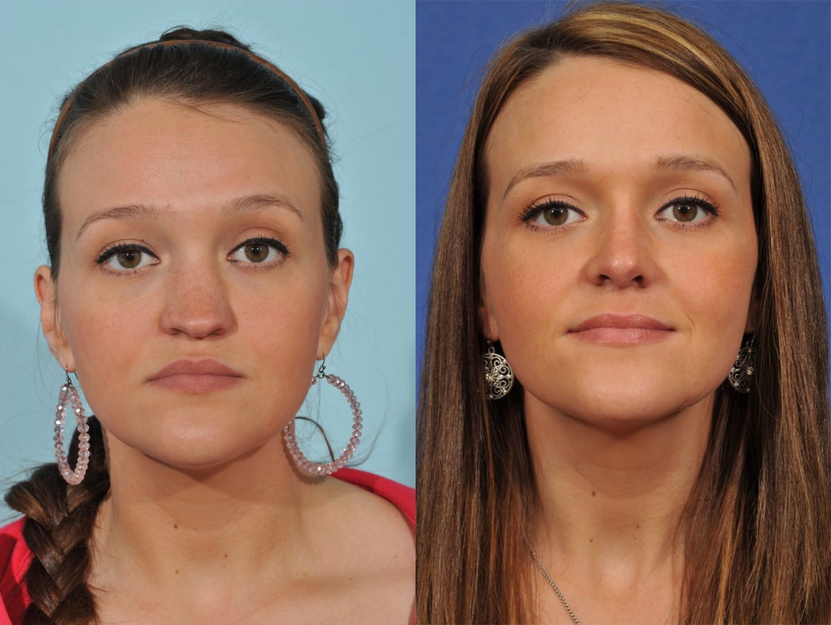 Rhinoplasty Before & After #3