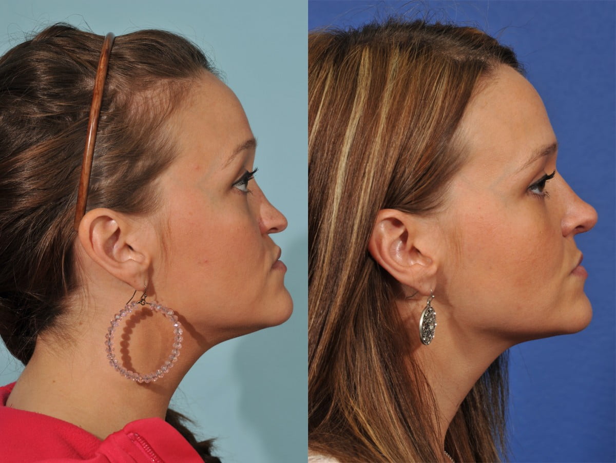 Rhinoplasty Before & After #3 image 2