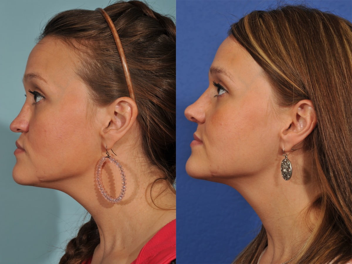 Rhinoplasty Before & After #3 image 3