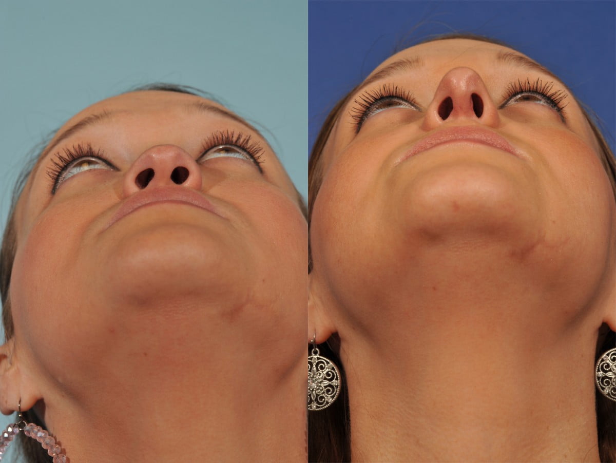 Rhinoplasty Before & After #3 image 4