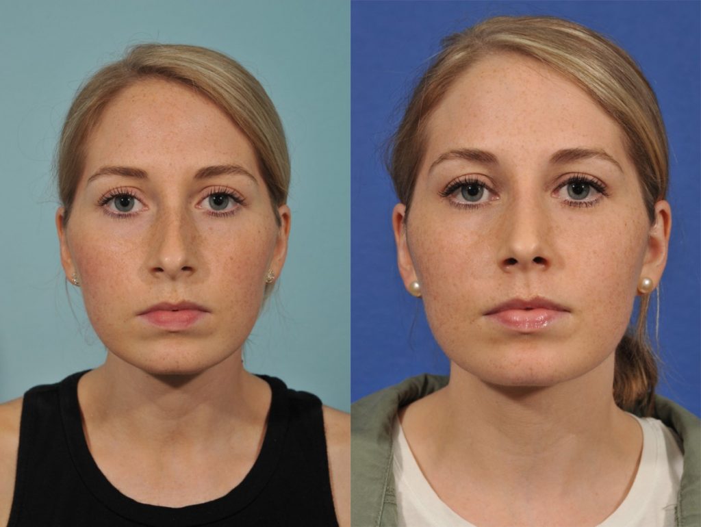 Rhinoplasty Before & After #5 before and after