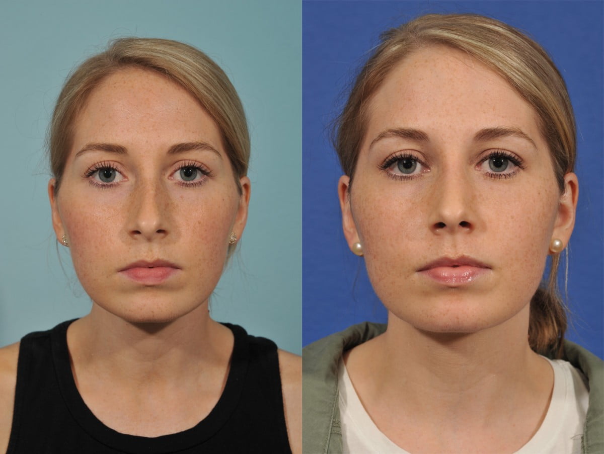 Rhinoplasty Before & After #5 image 1