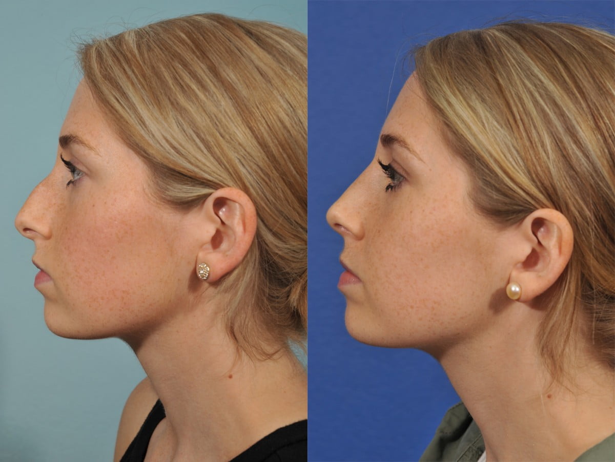 Rhinoplasty Before & After #5 image 2