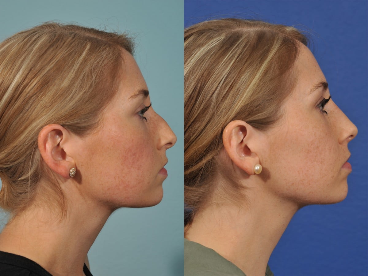 Rhinoplasty Before & After #5
