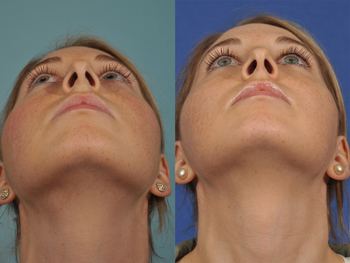 Rhinoplasty Before & After #5 image 4