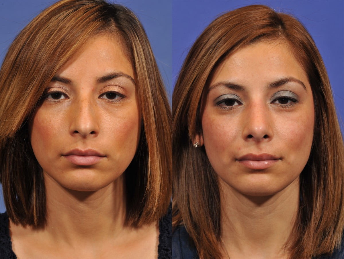 Rhinoplasty Before & After #6 image 1