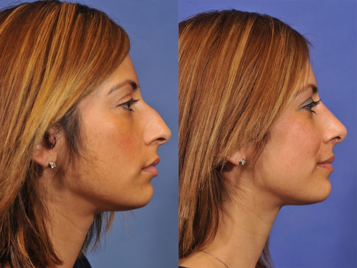 Rhinoplasty Before & After #6