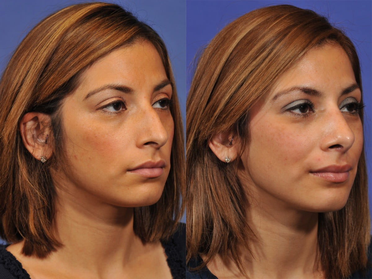 Rhinoplasty Before & After #6 image 3