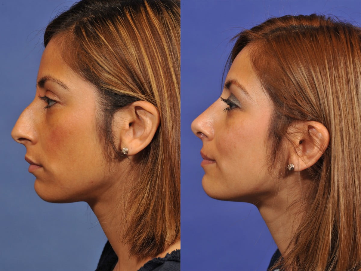 Rhinoplasty Before & After #6 image 4