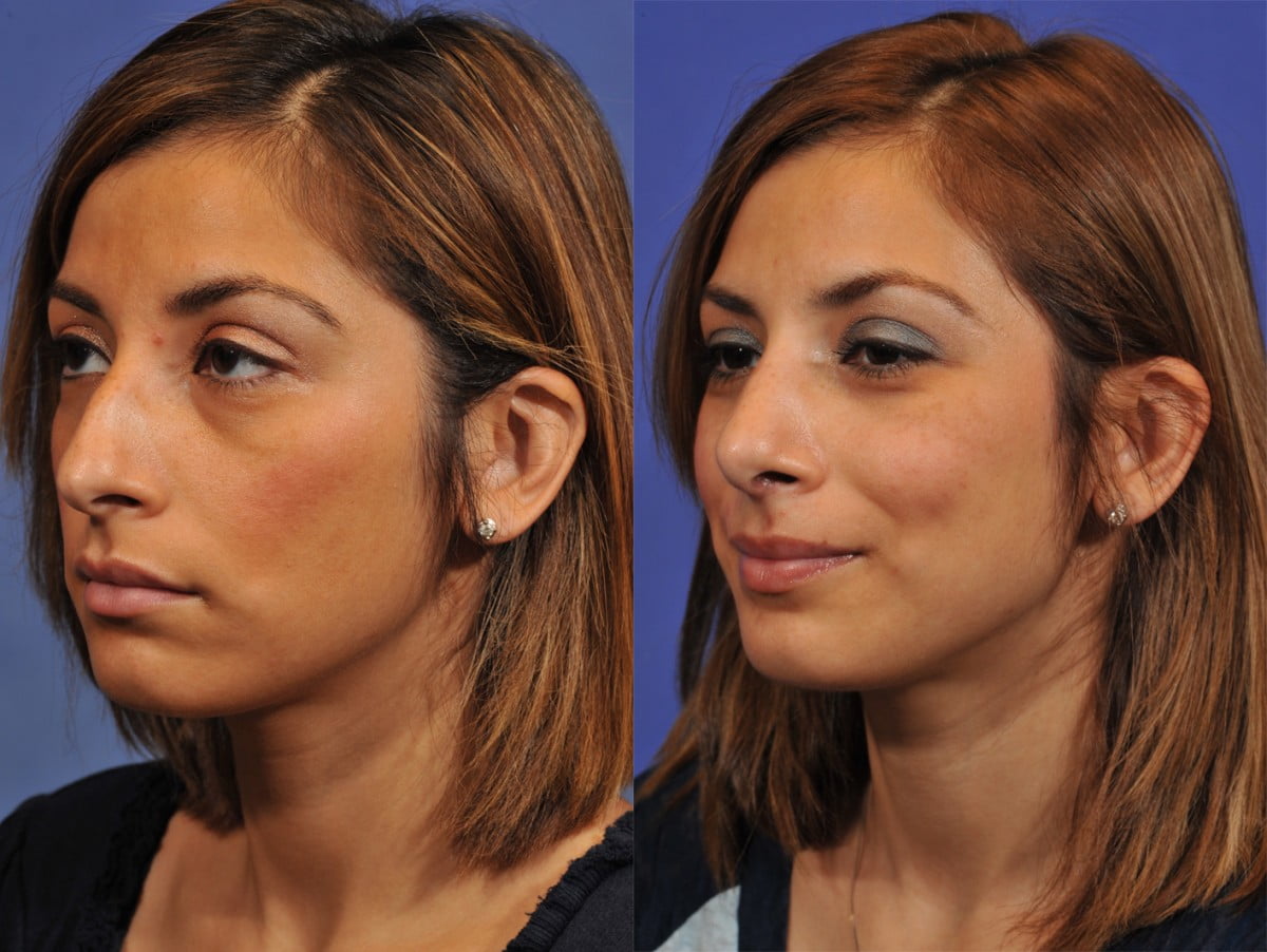 Rhinoplasty Before & After #6 image 5