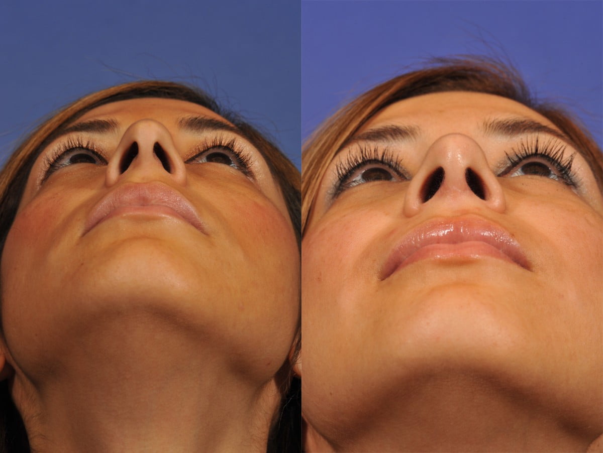 Rhinoplasty Before & After #6 image 6