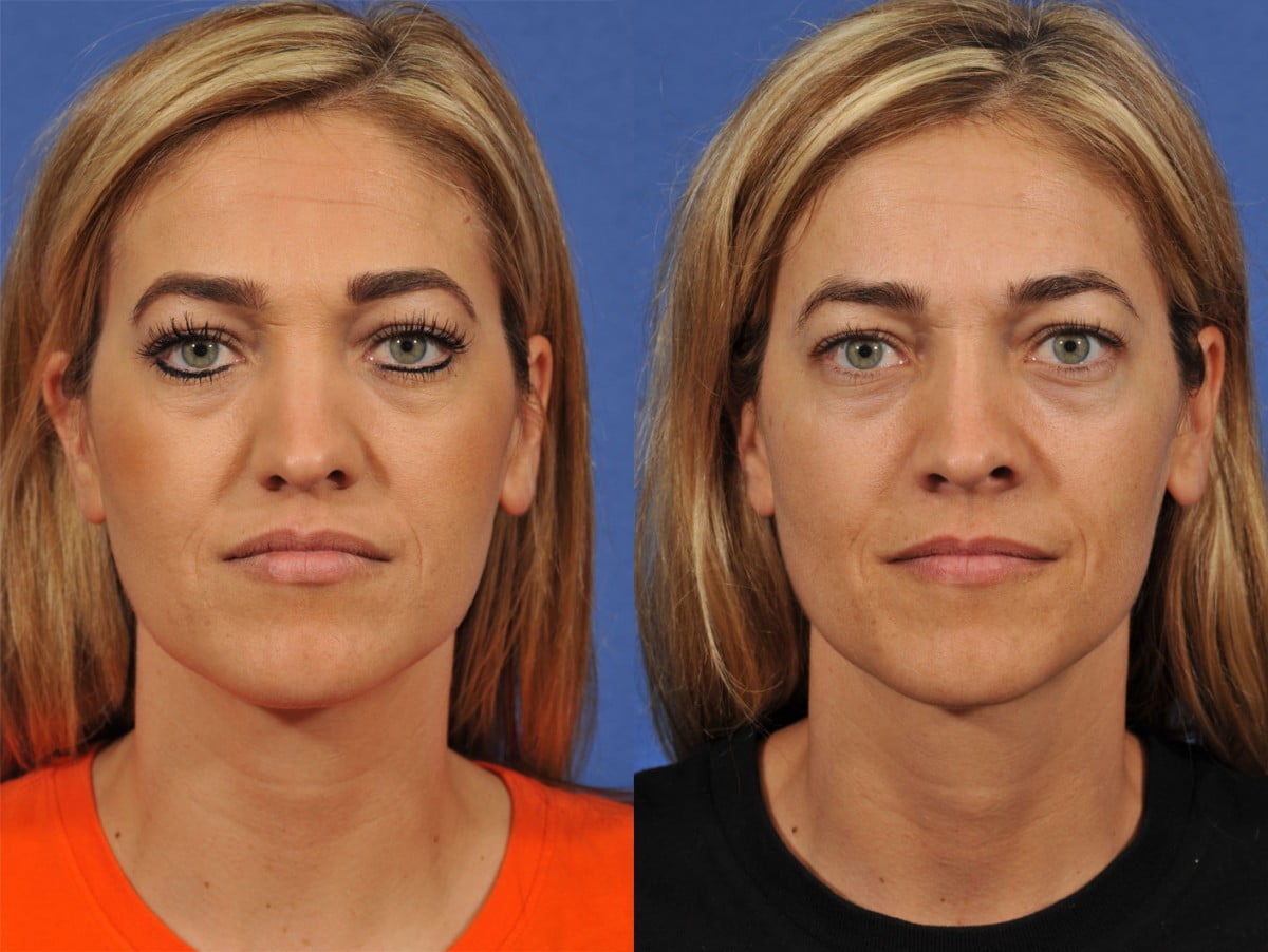 Rhinoplasty Before & After #7 image 1