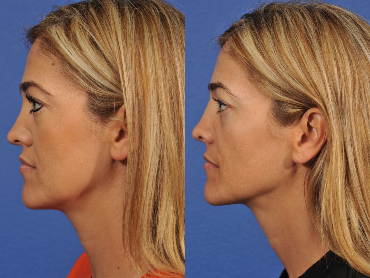 Rhinoplasty Before & After #7 image 2