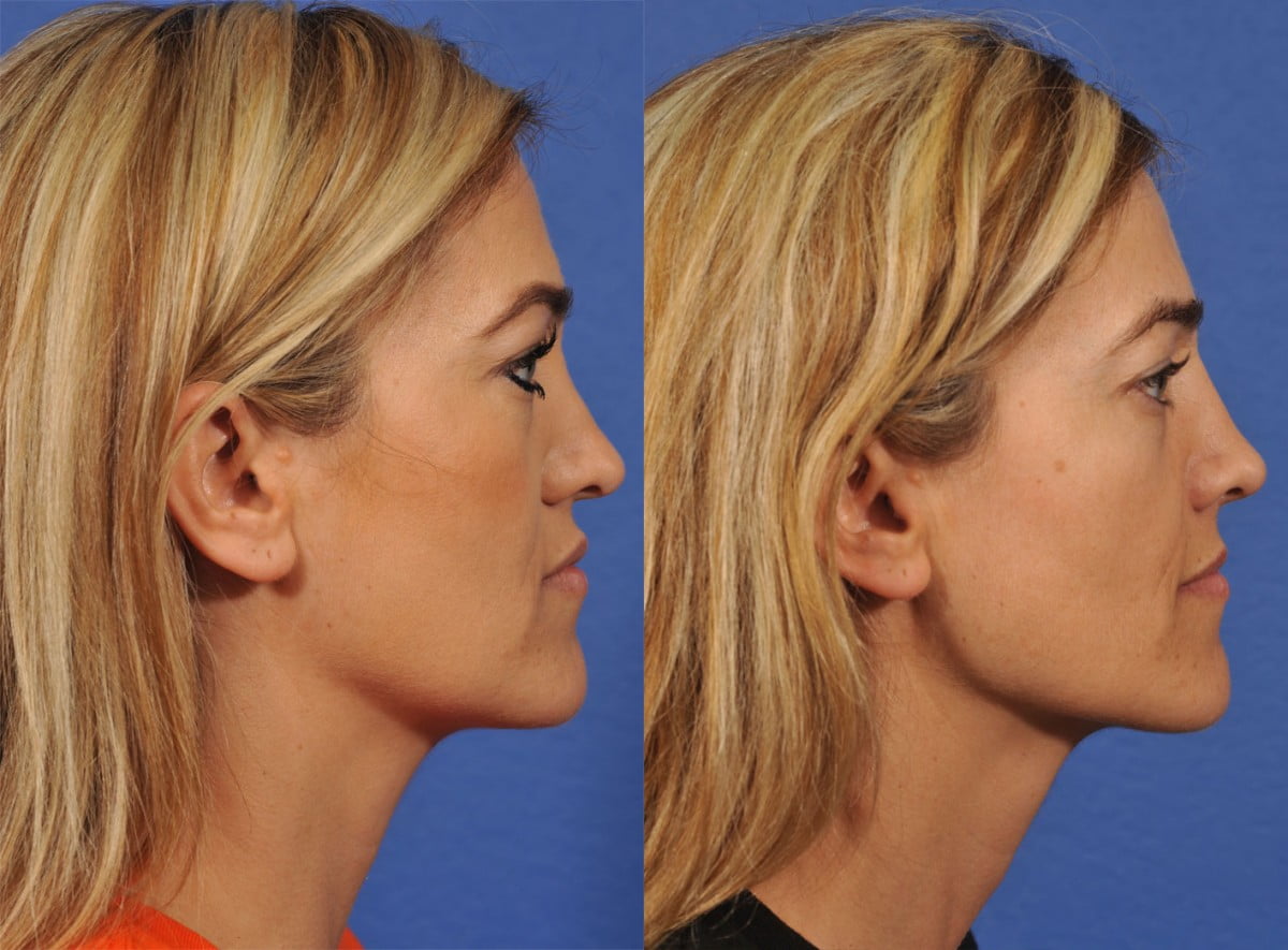 Rhinoplasty Before & After #7