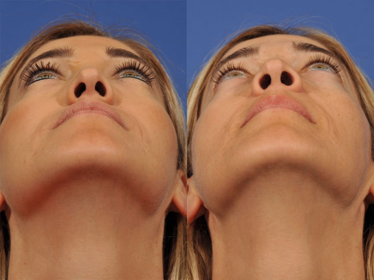 Rhinoplasty Before & After #7 image 4