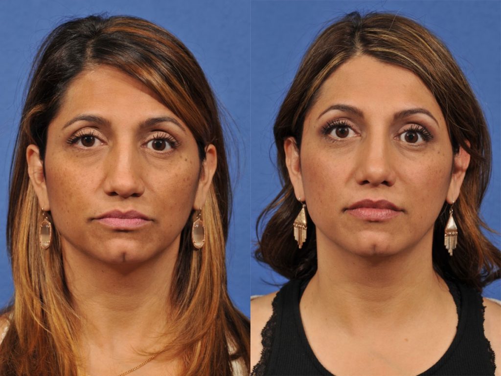 Rhinoplasty Before & After #8 before and after