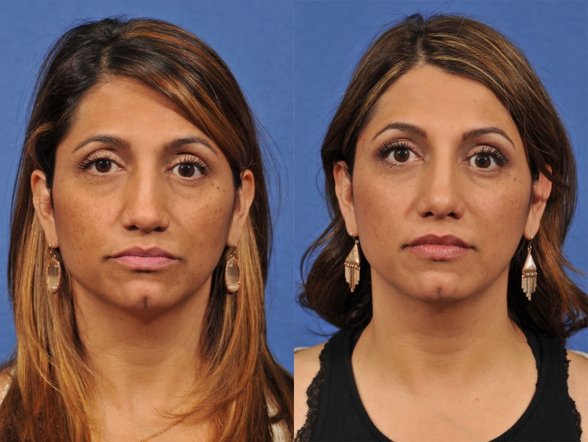 Rhinoplasty Before & After #8 image 1