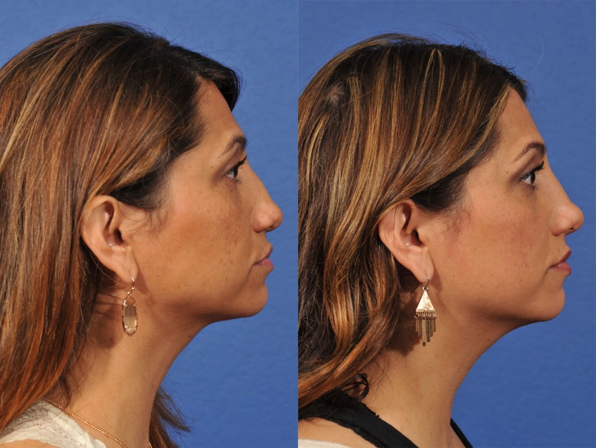 Rhinoplasty Before & After #8