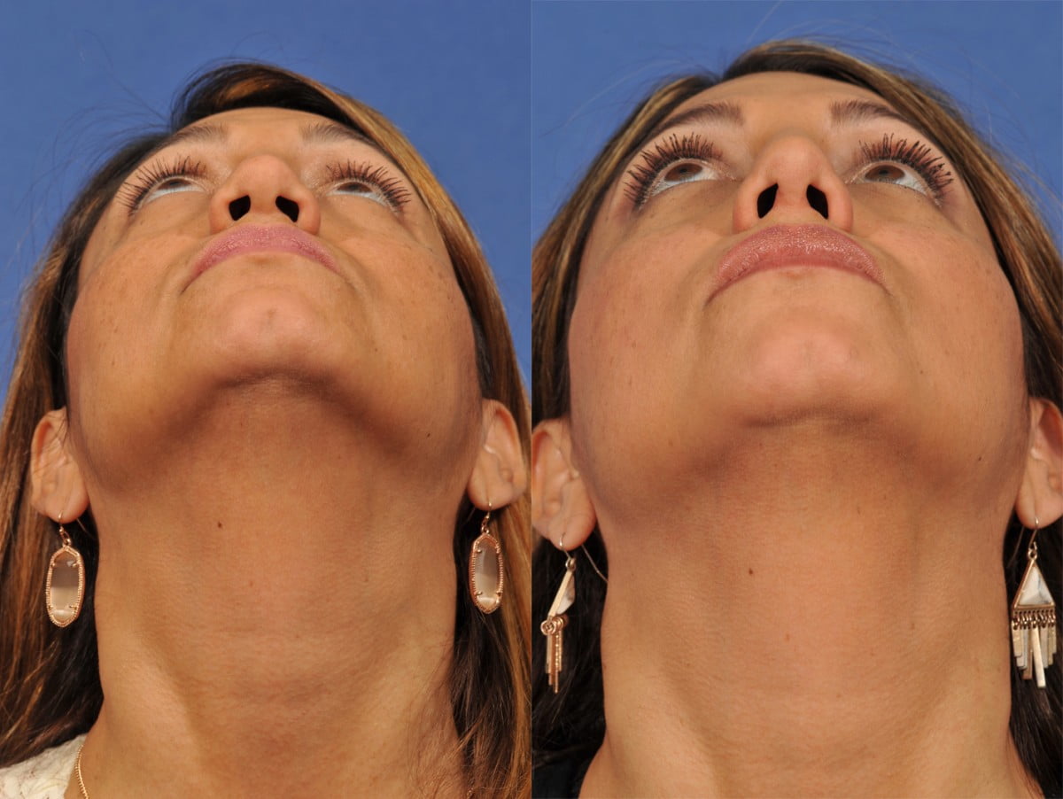 Rhinoplasty Before & After #8 image 3