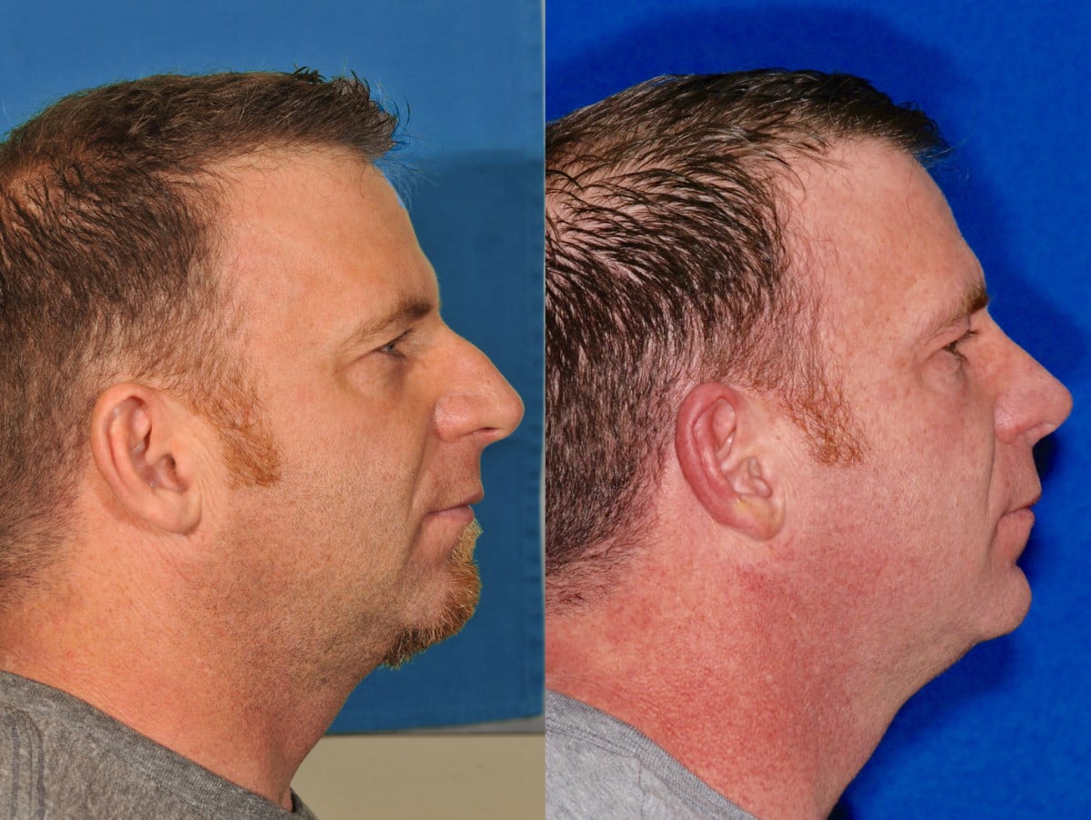 Rhinoplasty Before & After #9